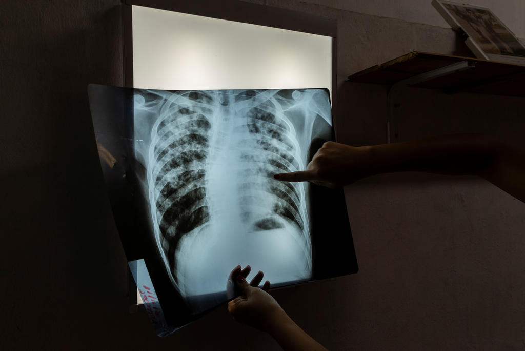 xray scan of lungs showing tuberculosis (Reuters)
